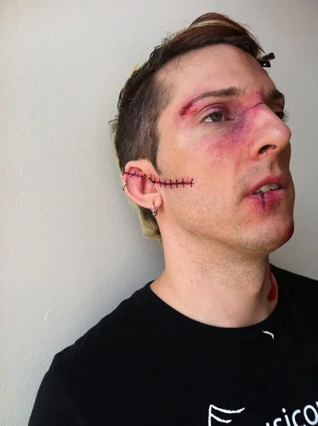 Healing wounds