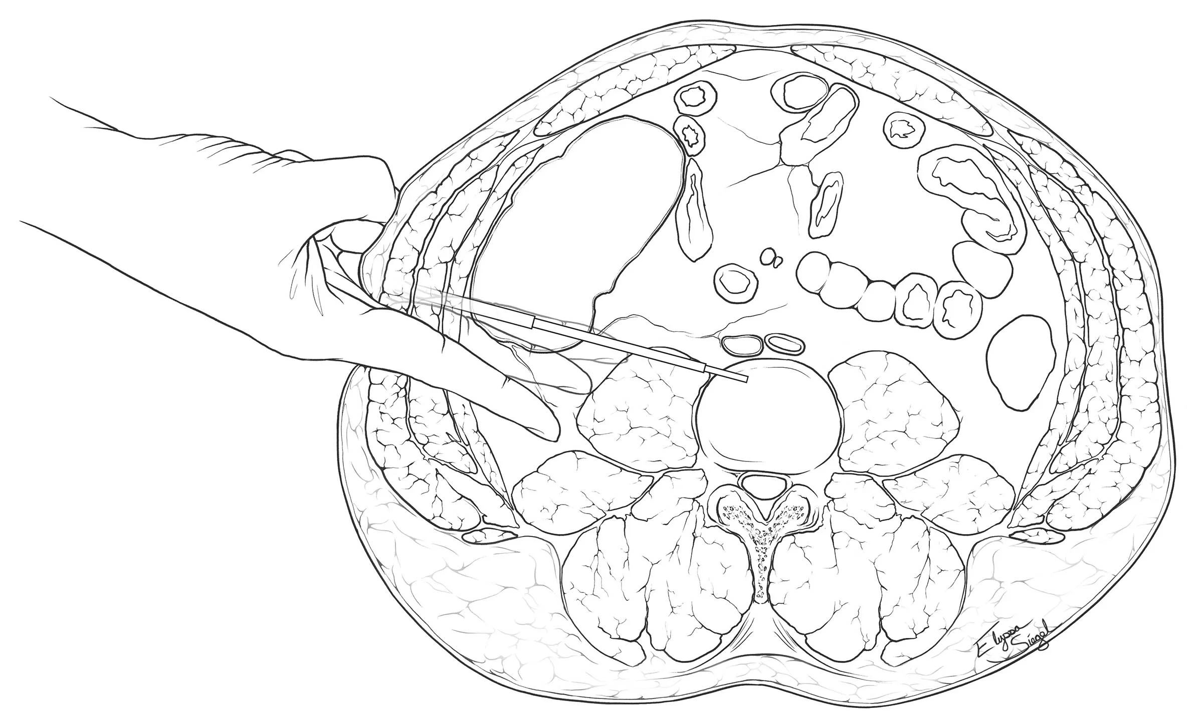 fig02_OLIF.jpg