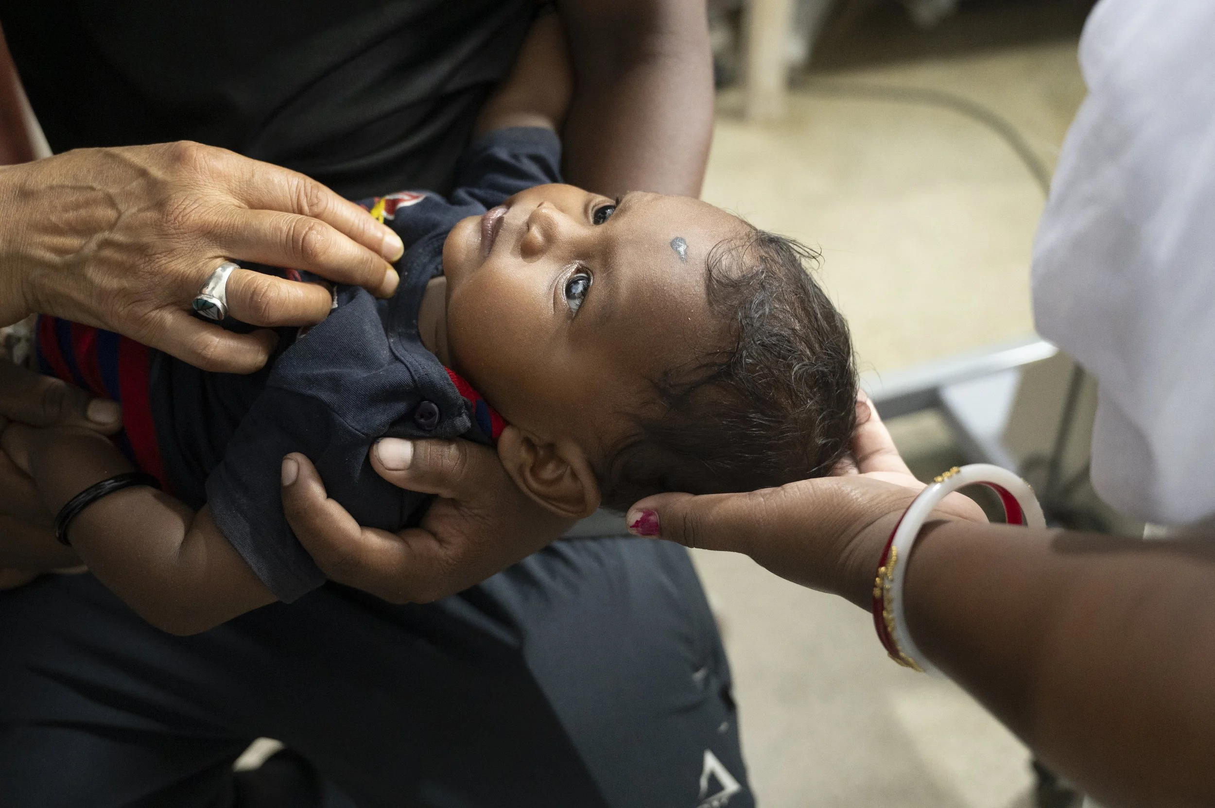 Devraj was born with cataract
