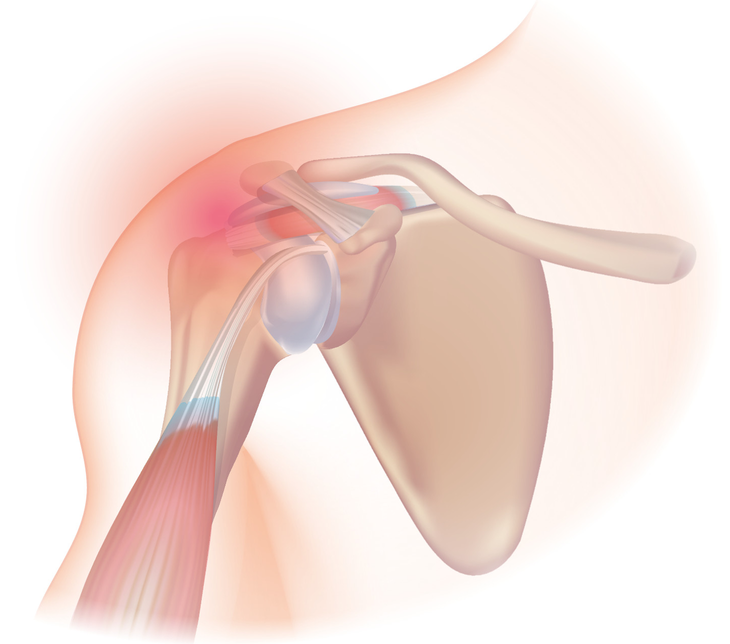 Img -  https://www.injurymap.com/diagnoses/rotator-cuff-syndrome