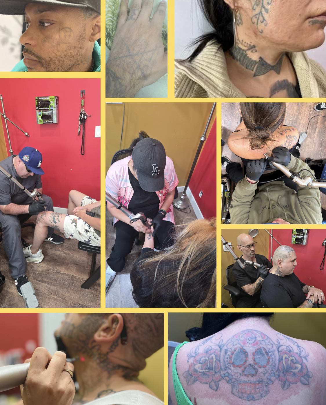 tattoo treatments, tattoo removal, los angeles, low fees, non profit