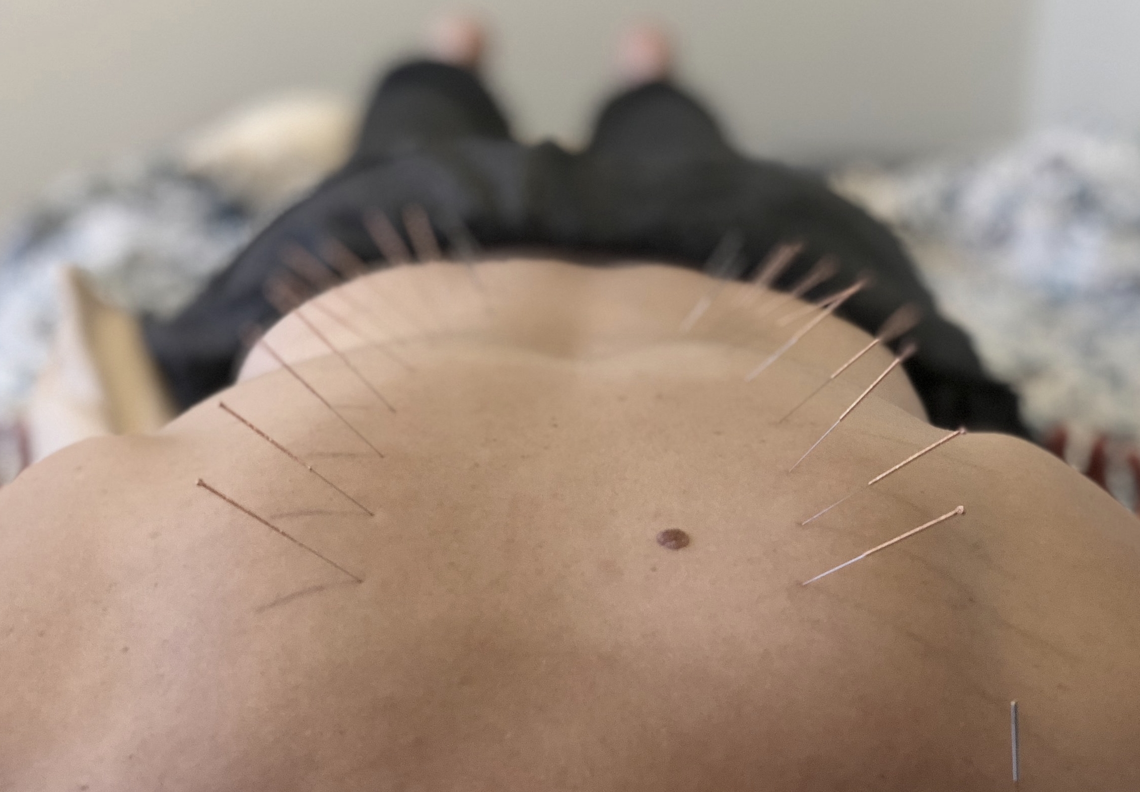 Acupuncture back treatment 