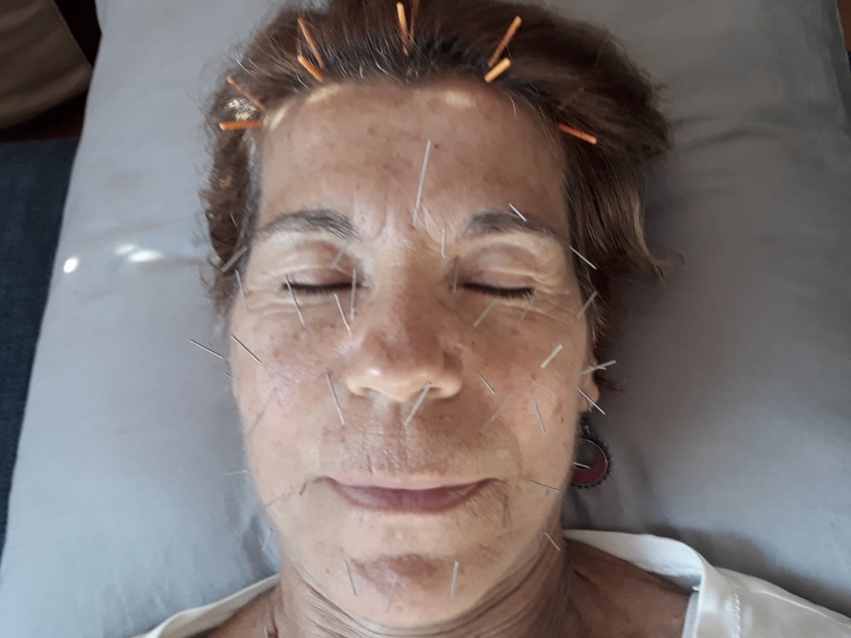 Facial Rejuvenation Acupuncture 