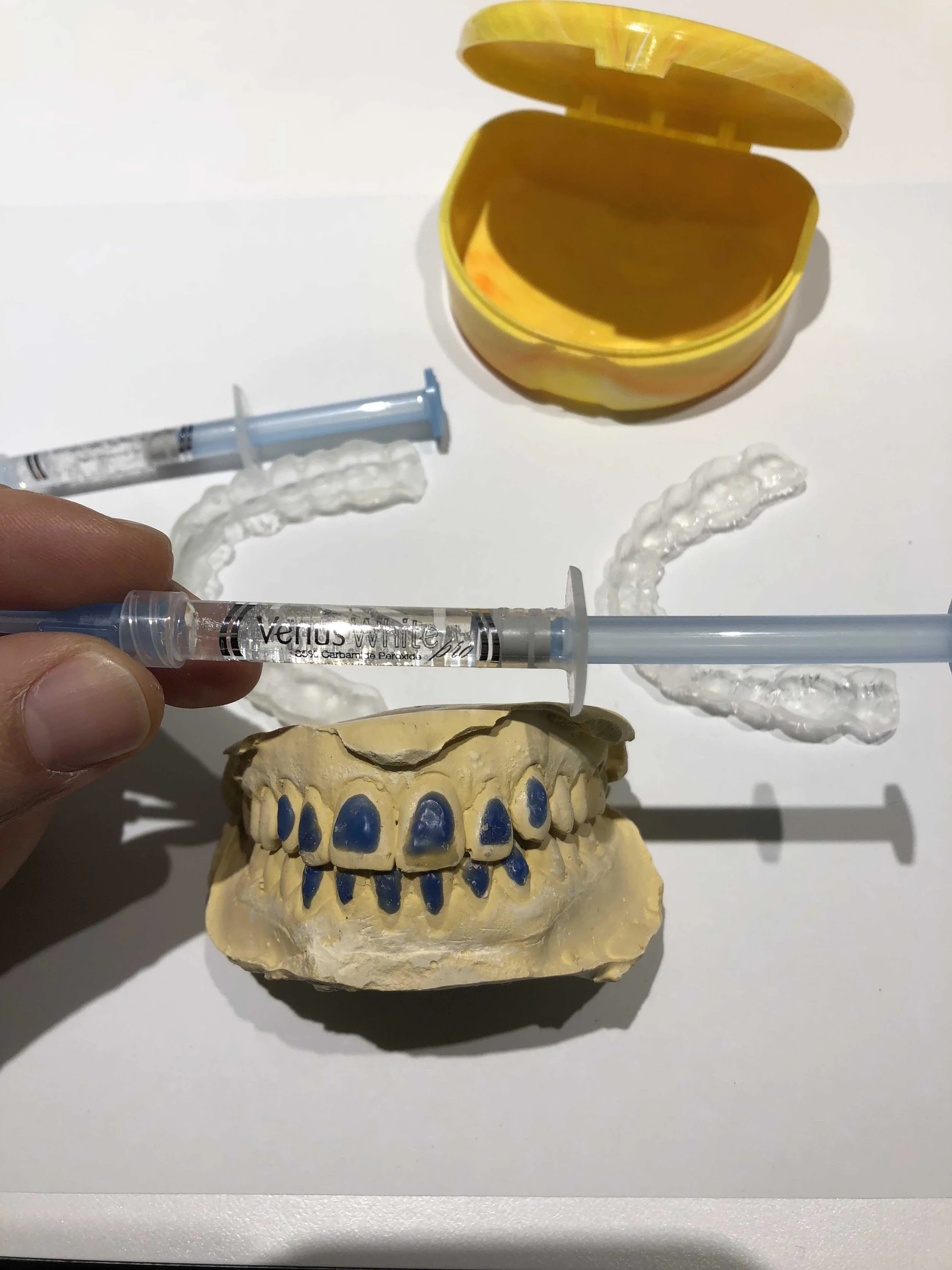 Our whitening system of choice: Venus White 35% Carbamide Peroxide by Kulzer Dental