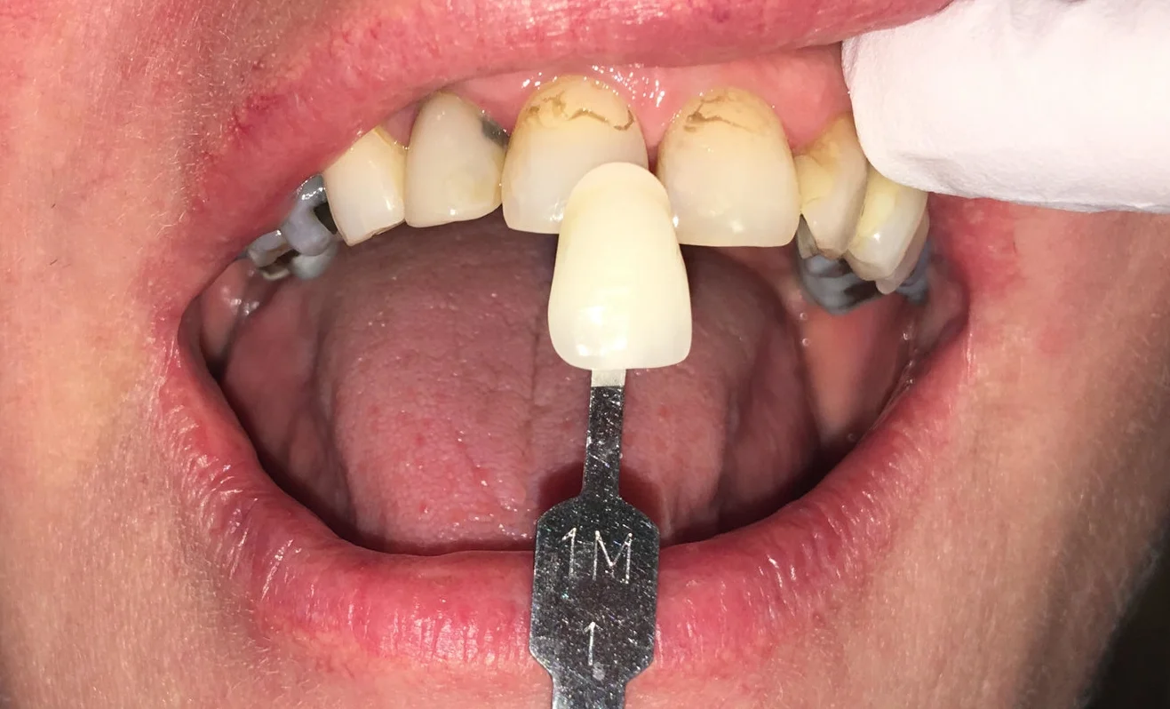 Prior to any tooth preparation we discuss what the patient would like as a final result. In regards to tooth shape and shade selection.