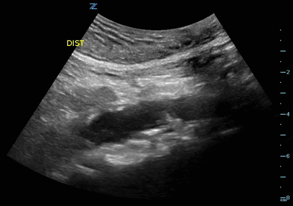 Distal aorta in long-axis.