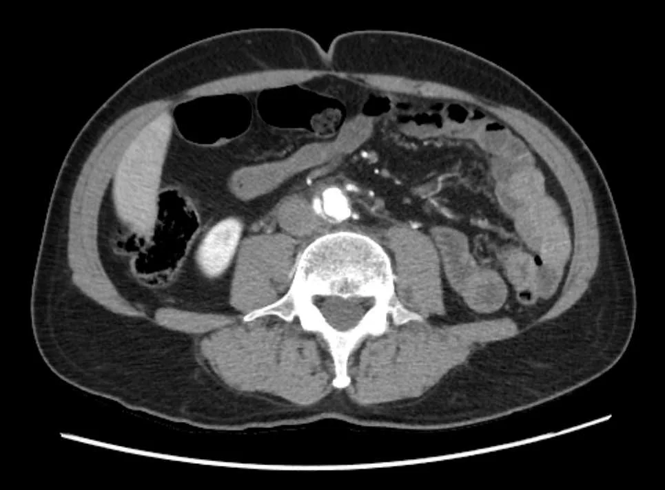 Aortic dissection is apparent as there are 2 separate enhancing lumens of the aorta.