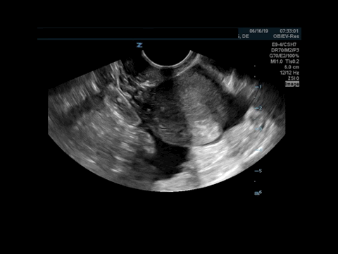On this first clip you see the uterus without any obvious gestational sac or sign of IUP. Notice that there is a moderate amount of free fluid within the pelvis surrounding the uterus.