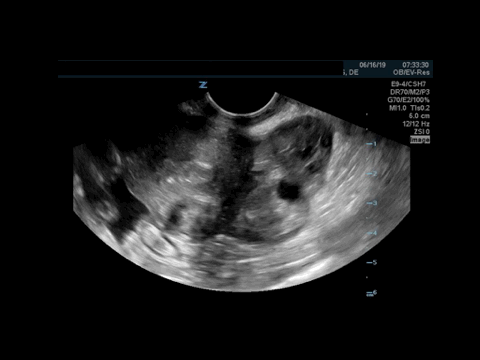 On this next clip we see the adnexa and the first thing we see is a structure that appears to be an ovary with small follicles within it. However, adjacent to it you will notice that there is an echogenic mass that doesn’t quite appear to be part of the ovary itself.
