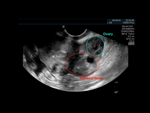 This clip highlights the distinct areas and the mass that his highly suspicious for an ectopic pregnancy.
