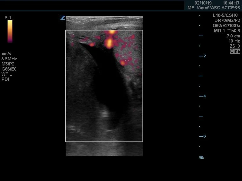 When compared with the contralateral testicle there is absent flow on power doppler.
