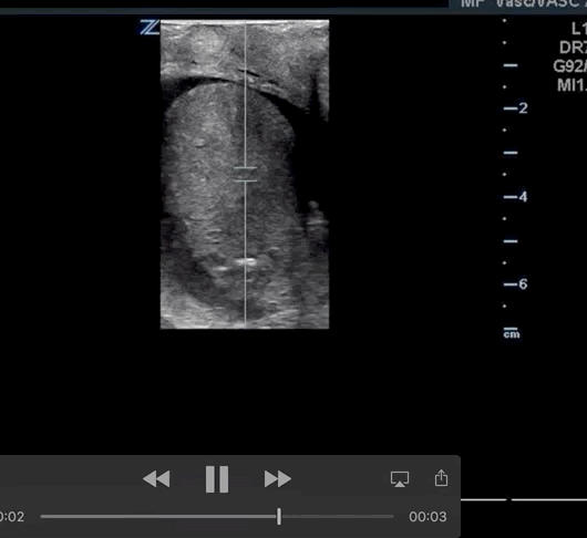 Note the absence of venous and arterial wave forms on pulse wave doppler.