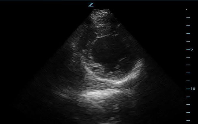 Parasternal short axis shows global hypokinesis, but more prominent in the septal and anterior wall.