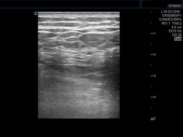 Injection of anesthetic just inferior to the erector spinae muscle plane
