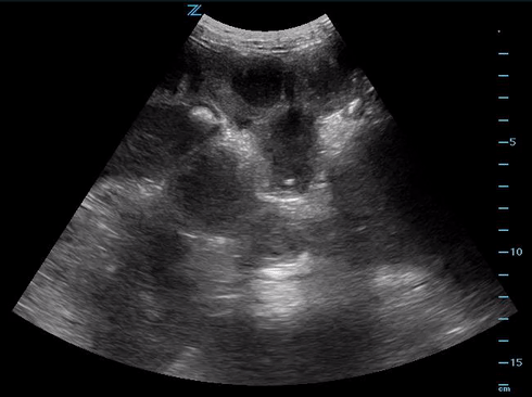 thick bowel.gif