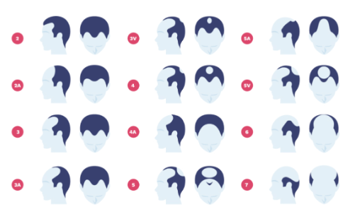 male pattern baldness hair loss for men alopecia in men penny james trichology center