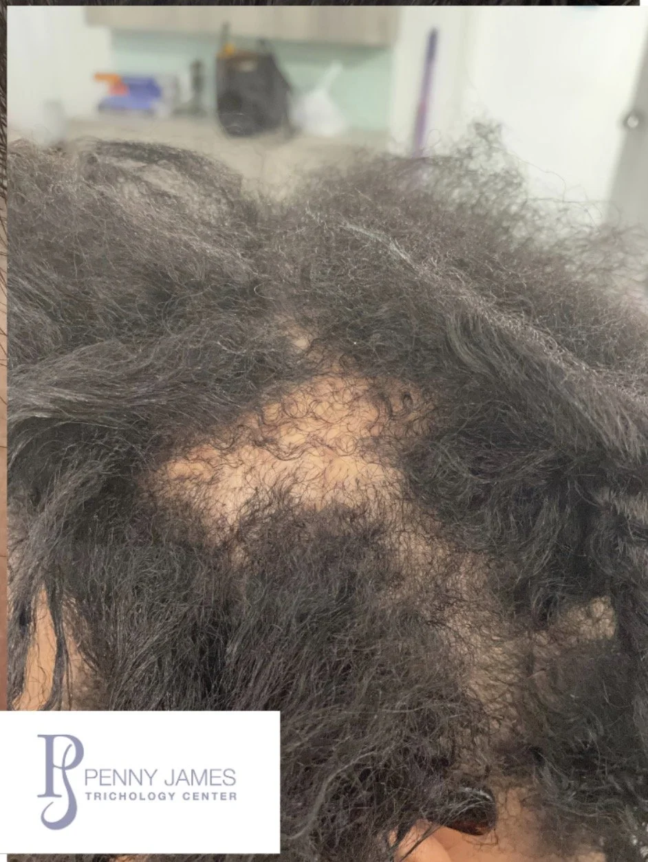 scarring alopecia expert trichologist new york city penny james hair loss specialist