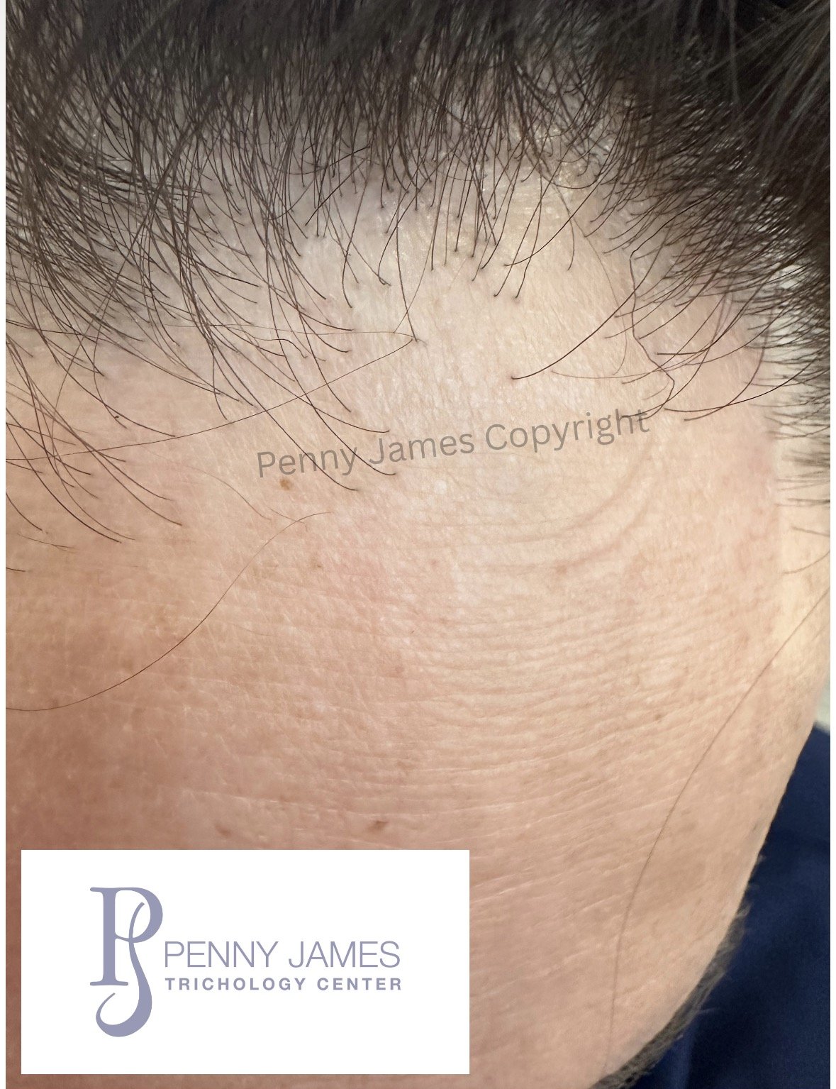scarring alopecia expert trichologist new york city penny james hair loss specialist