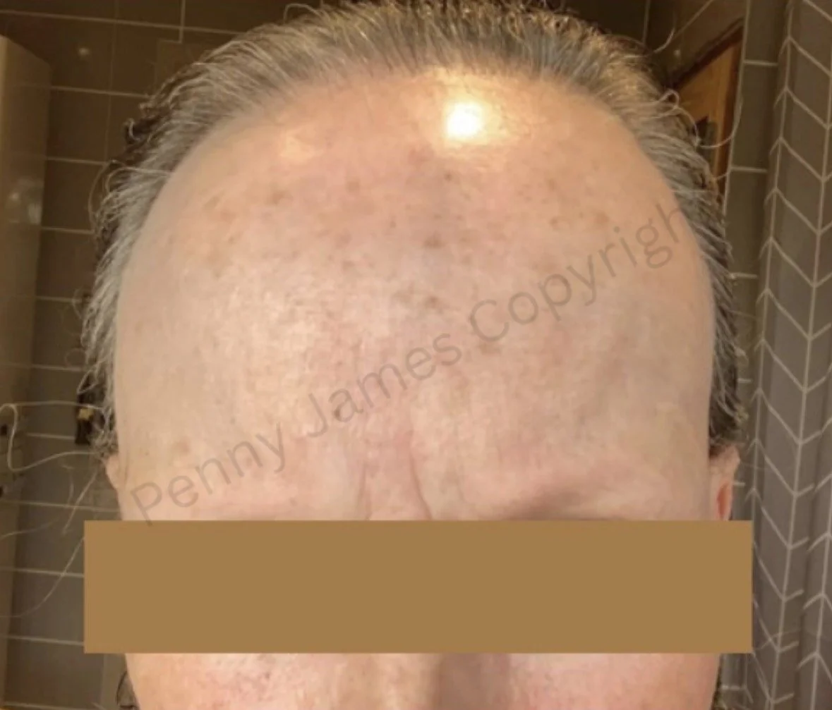 scarring alopecia expert trichologist new york city penny james hair loss specialist