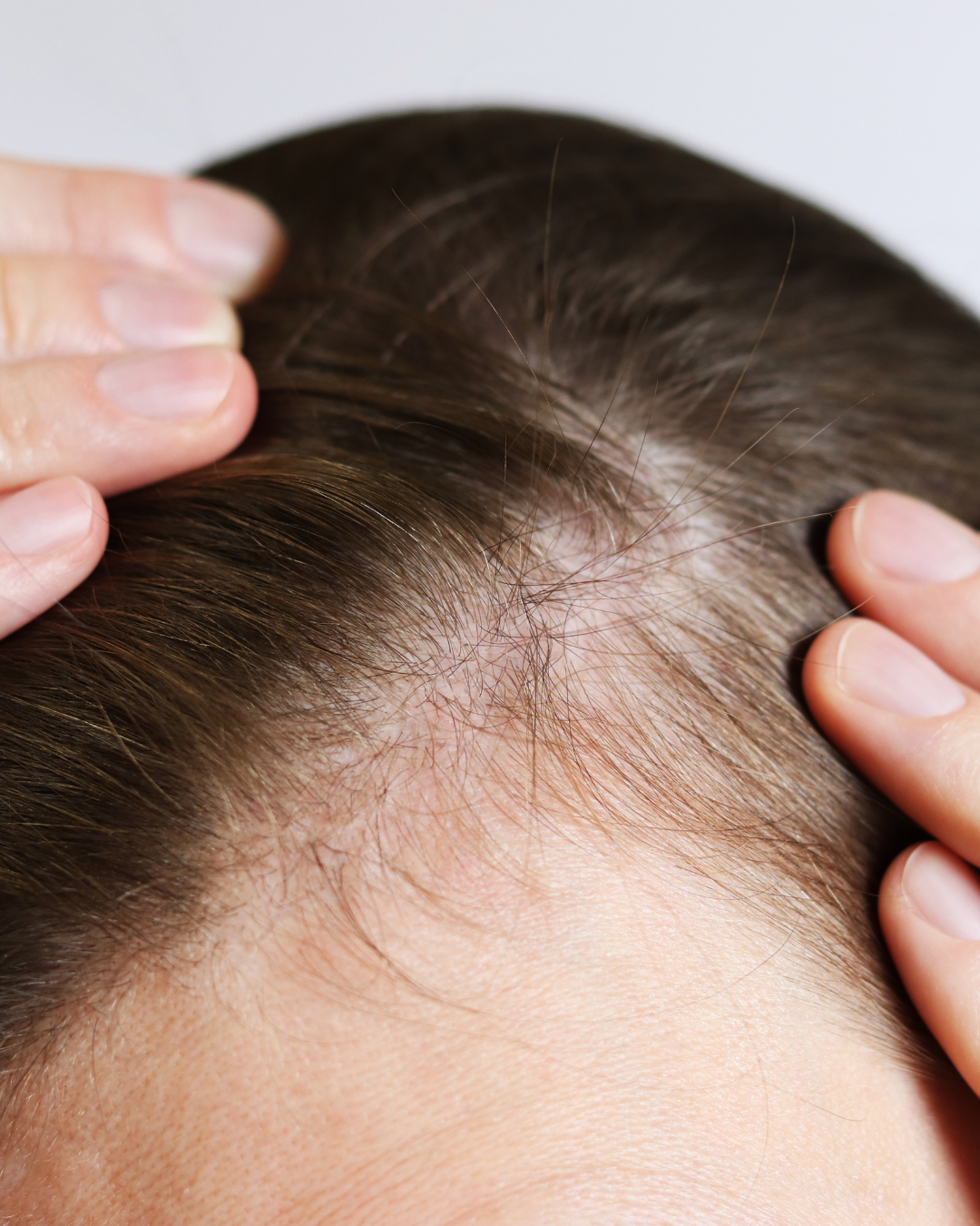 burning scalp why does my scalp burn alopecia specialist hair loss penny james trichologist nyc