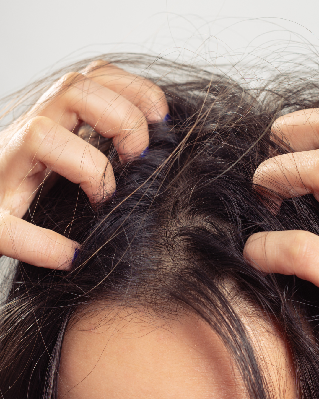 Why Your Scalp Itches This Time of Year—And What to Do About It