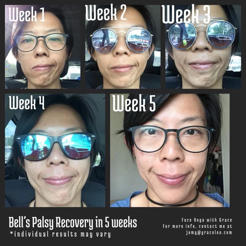 Student_of_Grace_Loo__Bell's_Palsy_Before_After.jpg