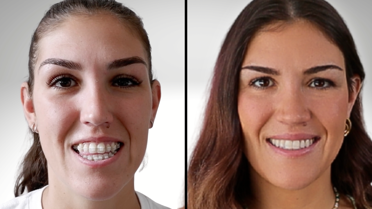 double jaw surgery results