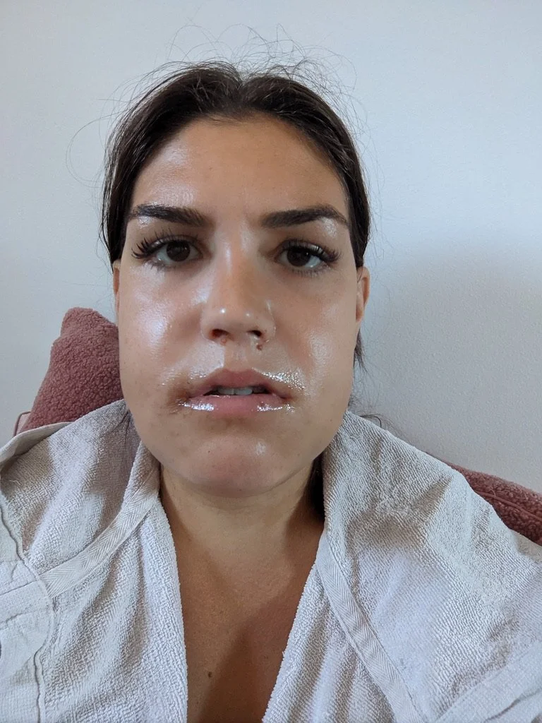 Jaw surgery recovery day 4 swelling