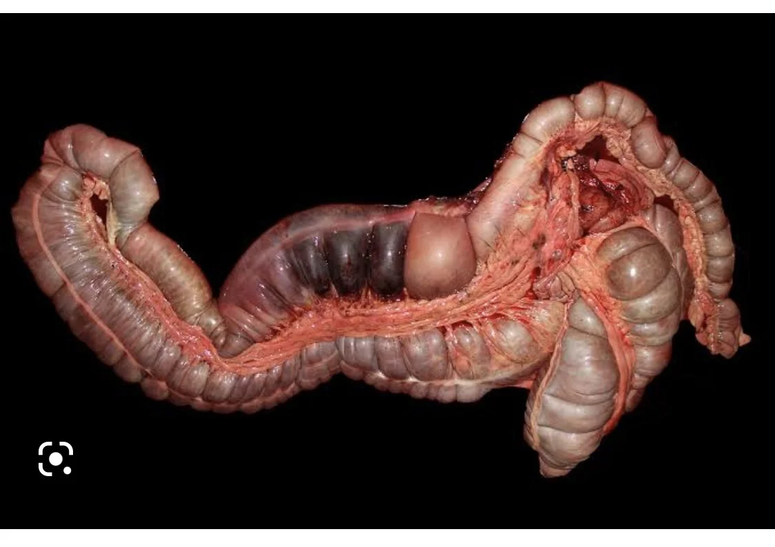 Right Dorsal Colitis