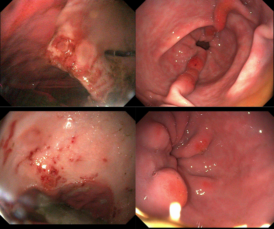 Glandular Gastric Ulcers in Horses: Why Ulcershield Isn’t Enough