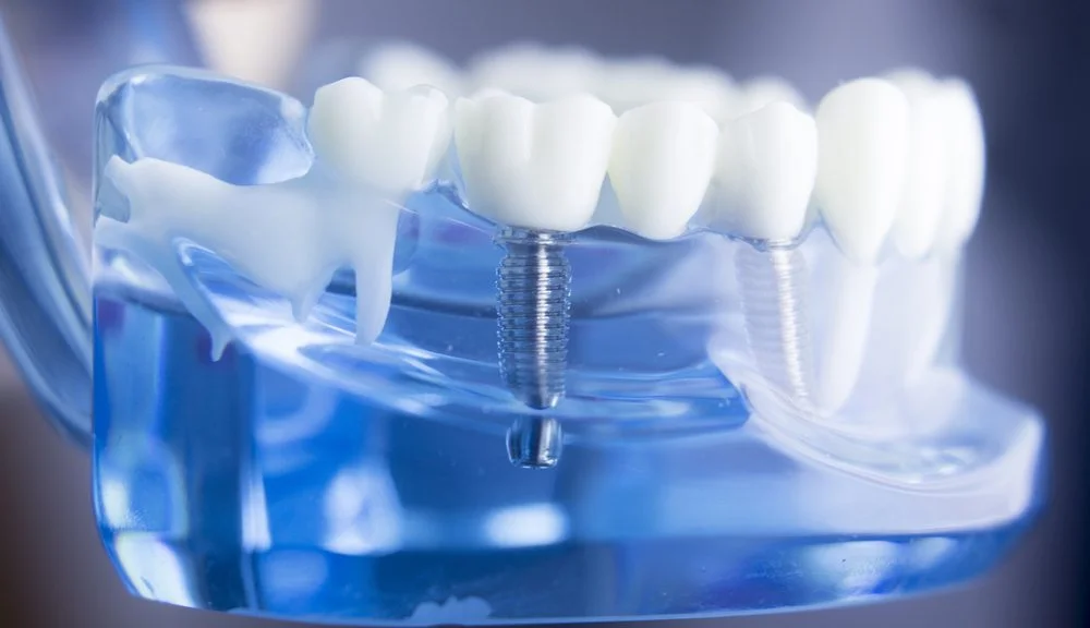 dental implants.jpg