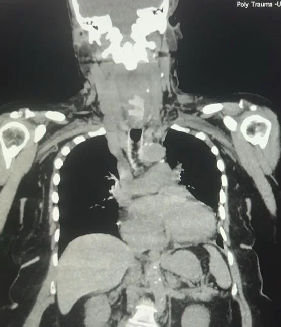 Successful Surgical Removal of Lodged Denture at Wockhardt Hospitals, Mira Road 
