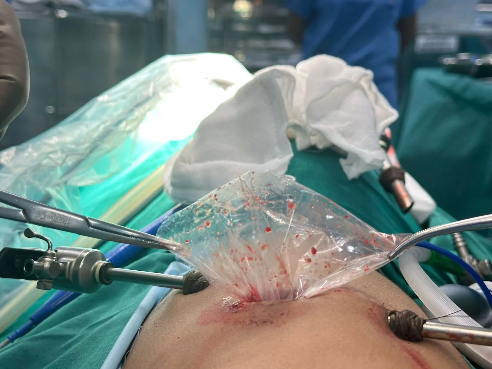 Narayana Health SRCC Children’s Hospital, Mumbai Successfully Treats Rare Mediastinal Mass extending into abdomen in a 7-Year-Old Girl Using Advanced Thoracoscopic Surgery 