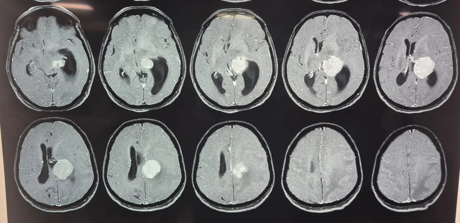 65-Year-Old Woman Gets New Lease of Life After Successful Removal of Rare Brain Tumour