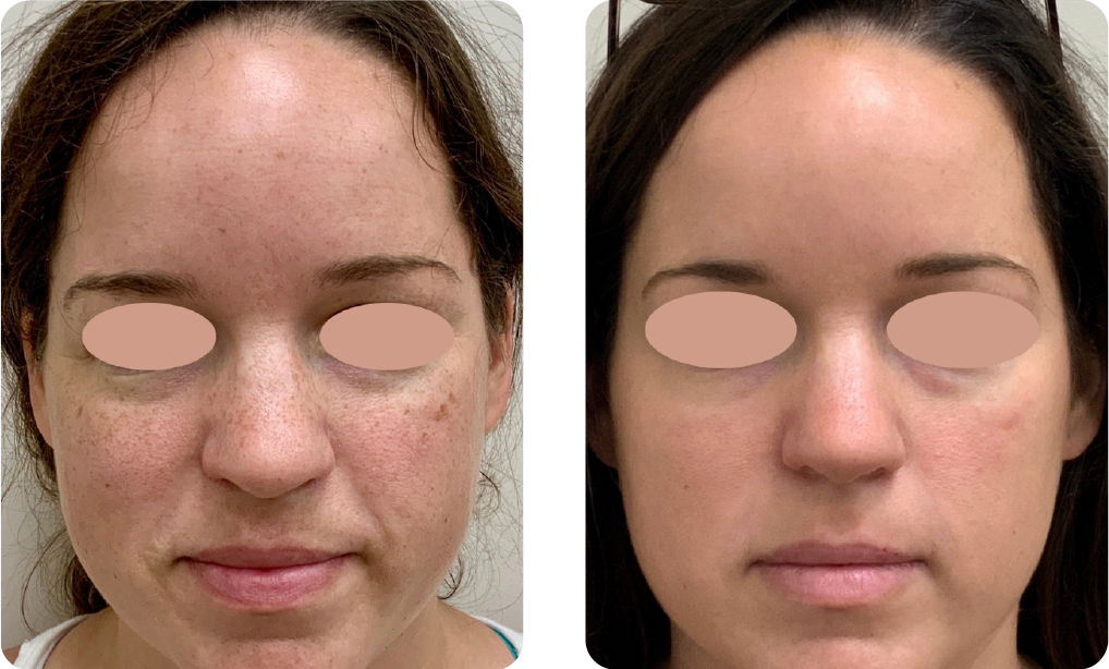 Skin Rejuvenation - After 1 Treatment