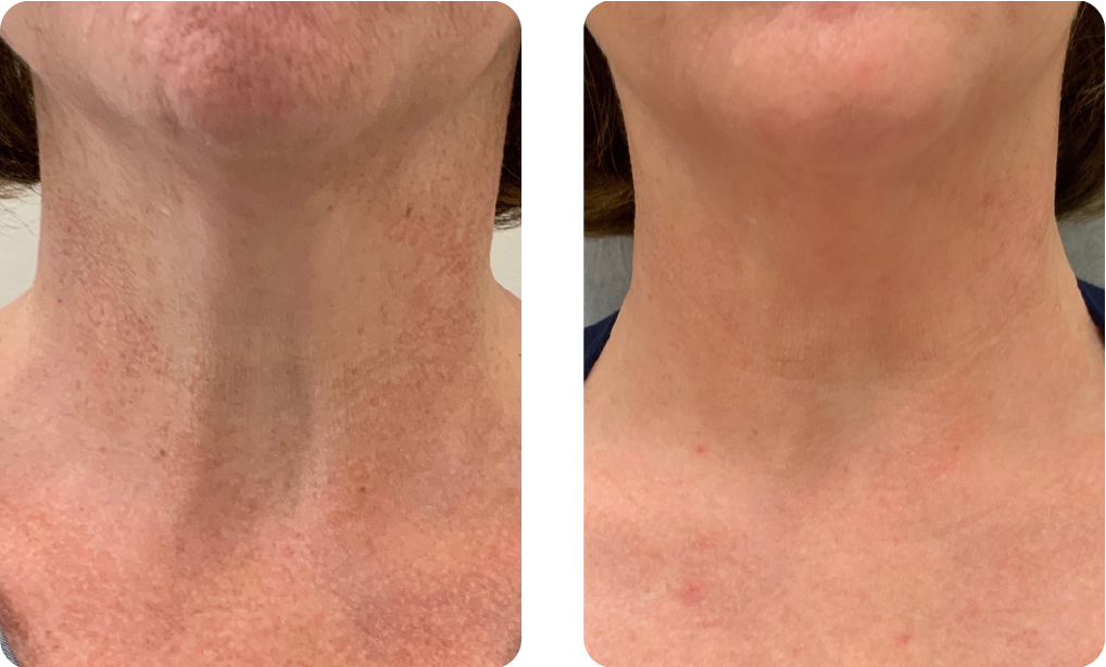 Laser for Neck Texture and Color