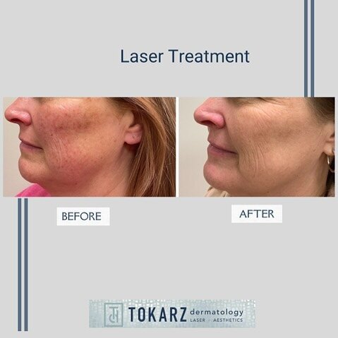 ✨Happy Patient after just one laser treatment!  Thrilled with results&hellip;.

#laserdoctor 
#tokarzdermatology 
#healtyskin