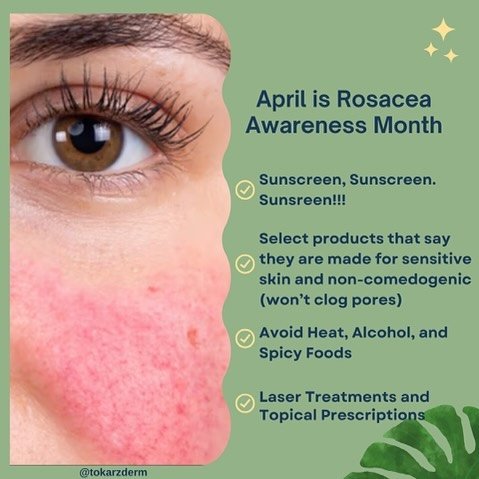 Struggling with Rosacea?  Here are a few tips  from Dr. Tokarz to help control Rosacea Flare-ups. 

#rosaceaawarenessmonth 
#laserdoctor
#tokarzdermatology 
#rosacea