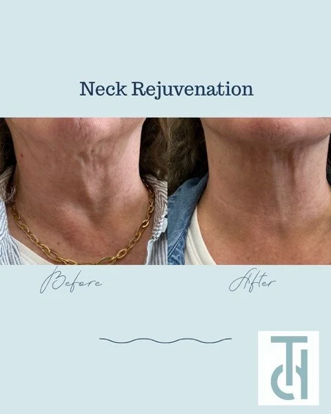 Happy Patient Alert!  This patient was  so thrilled with the improvement of her neck&hellip;  Is your aging neck bothering you?  Dr.  Valerie Tokarz can  help 👏

#tokarzdermatology
#necktransformation
#eastgreenwuchri