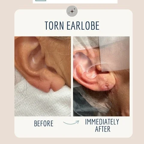 Torn or Stretched Earlobes?  We Can Fix That!  Our in-office earlobe repair treatment restores your natural ear contour - so you can wear your favorite earrings again with confidence. 👩&zwj;⚕️ Preformed by Dr. Valerie Tokarz,  board certified dermat