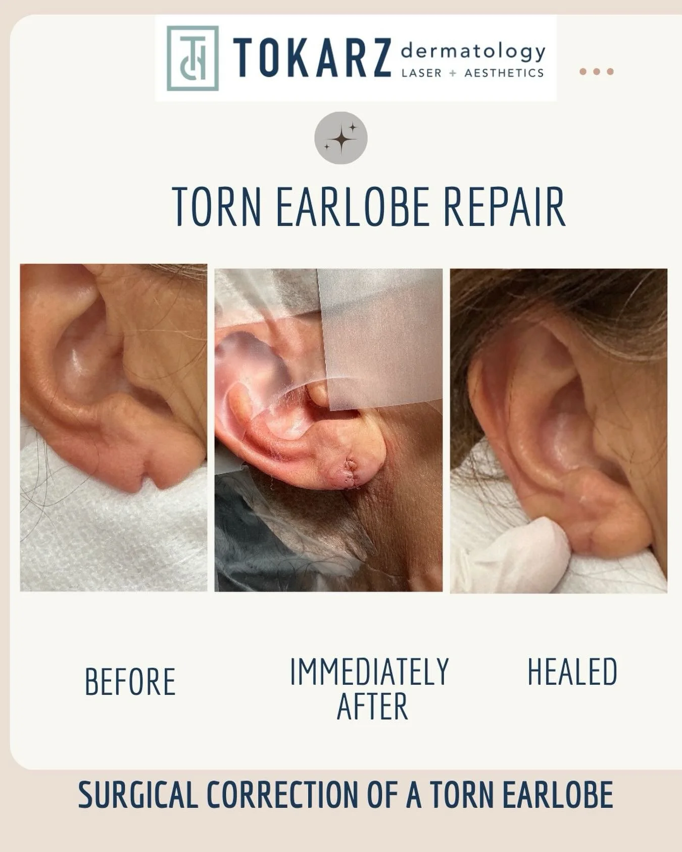 Earlobe Repair!