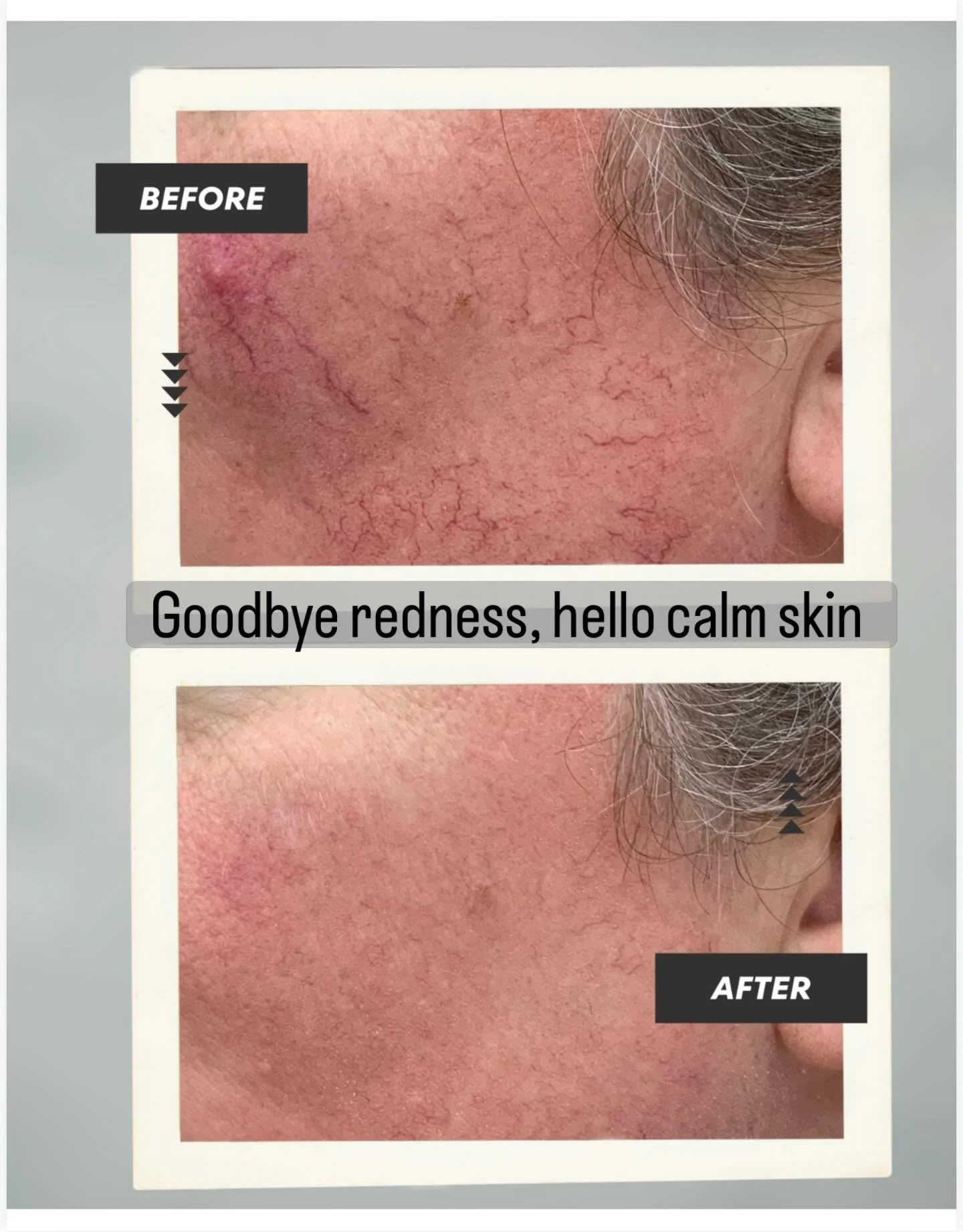 For this patient, we used targeted vascular laser treatments to gently heat and collapse unwanted vessels without harming the surrounding skin. Results typically require a series of sessions spaced several weeks apart, and may vary depending on sever