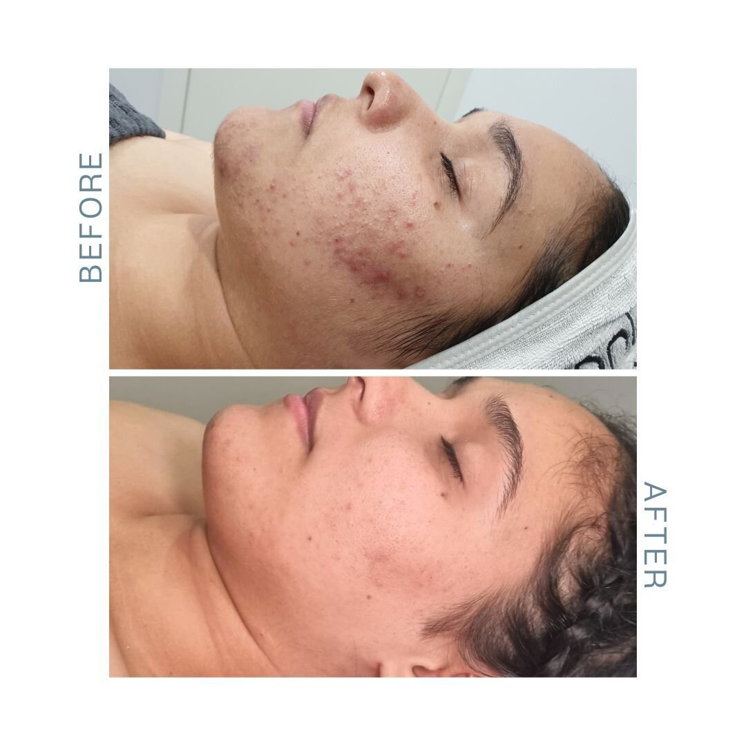 🌟 Transforming skin, transforming confidence! Just look at the incredible journey our client has embarked on with a personalized treatment plan of Geneo Balance, LED Light Therapy and Fusion Mesotherapy treatments. The results speak for themselves &