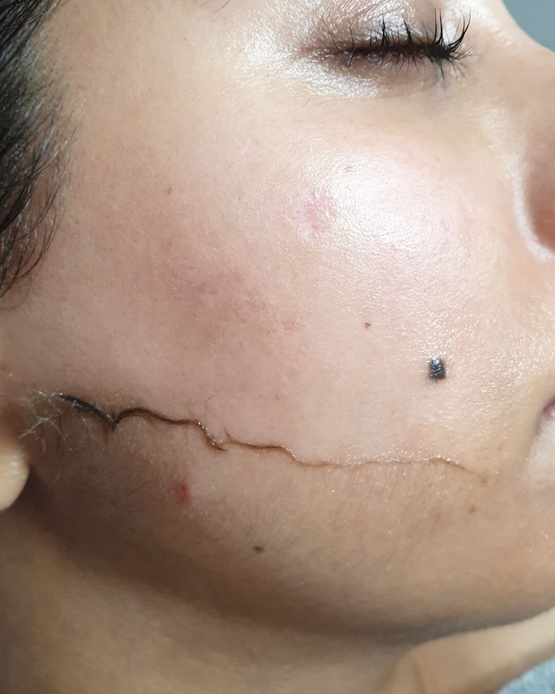 Are you looking for a way to get smoother, softer skin?

Epidermal levelling aka Dermaplaning is the perfect solution!

This non-invasive treatment works to remove the outermost layers of the epidermis as well as removing fine vellus hair (that peach