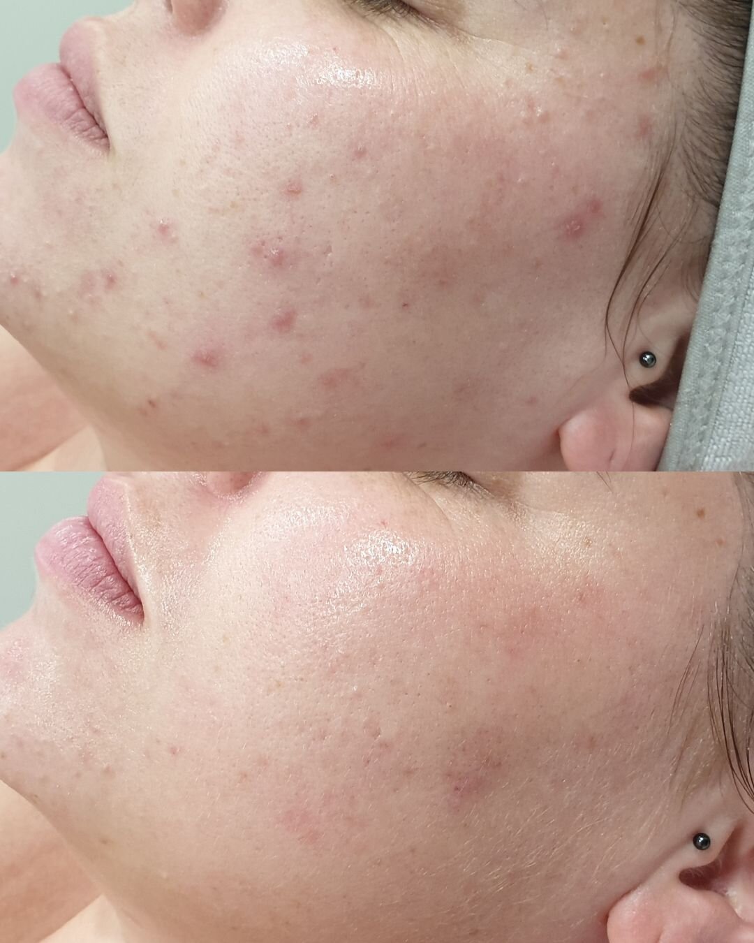 This is #progress 🙌

Our beautiful client originally came to us with compromised skin, concerned with congestion. Her journey started with Lymphatic Therapy to flush any toxins and increase nutrient absorption to begin healing and strengthening the 