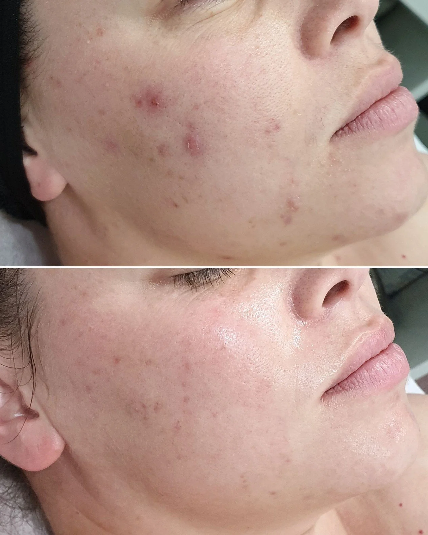 This is #progress 🙌

Our beautiful client originally came to us with compromised skin, concerned with congestion. Her journey started with Lymphatic Therapy to flush any toxins and increase nutrient absorption to begin healing and strengthening the 