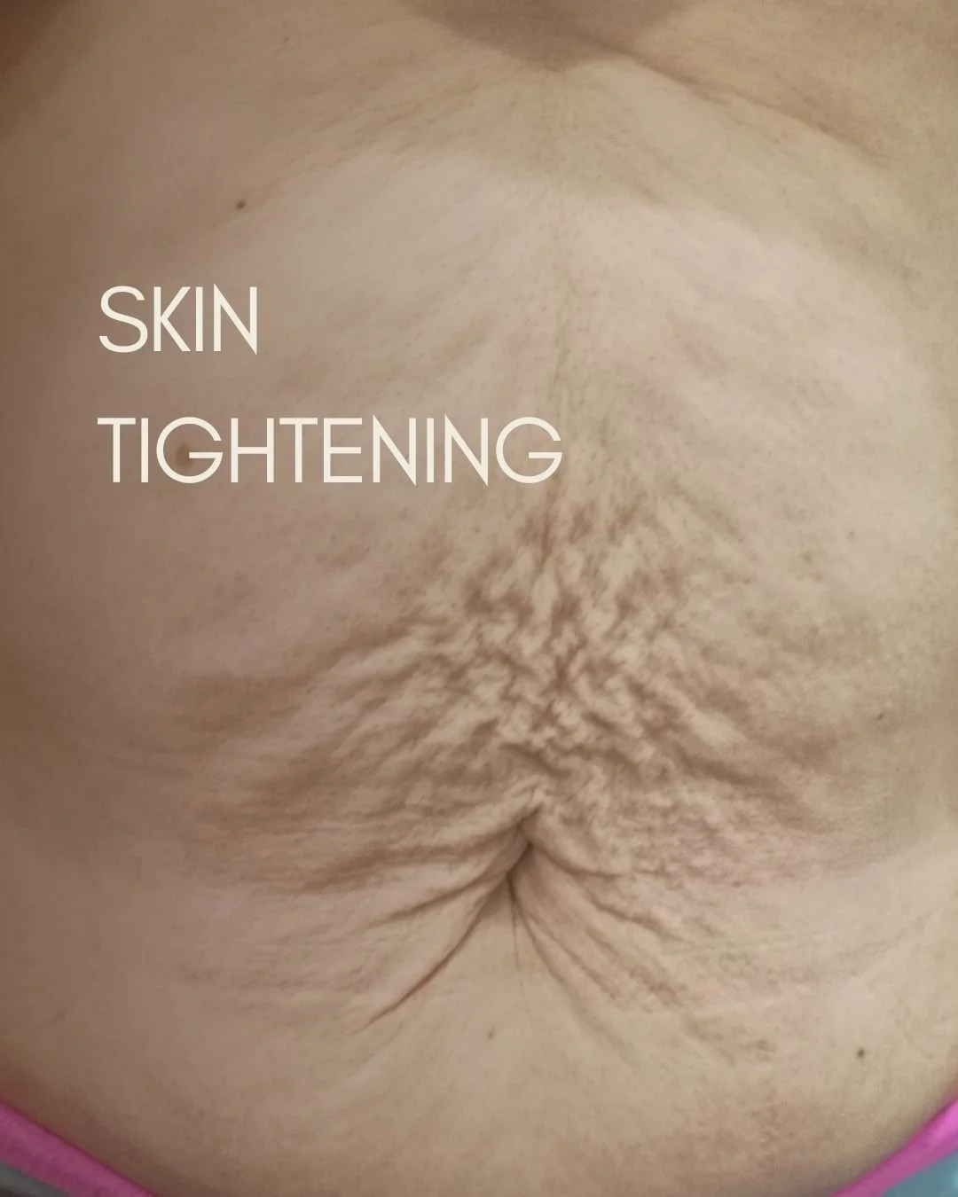 Plasma Fibroblast is a revolutionary treatment that works with your body's natural healing process to tighten and lift your skin. 🔥🔆

Check out the incredible progress from just a few of our clients

We're not here to change you, we're here to empo