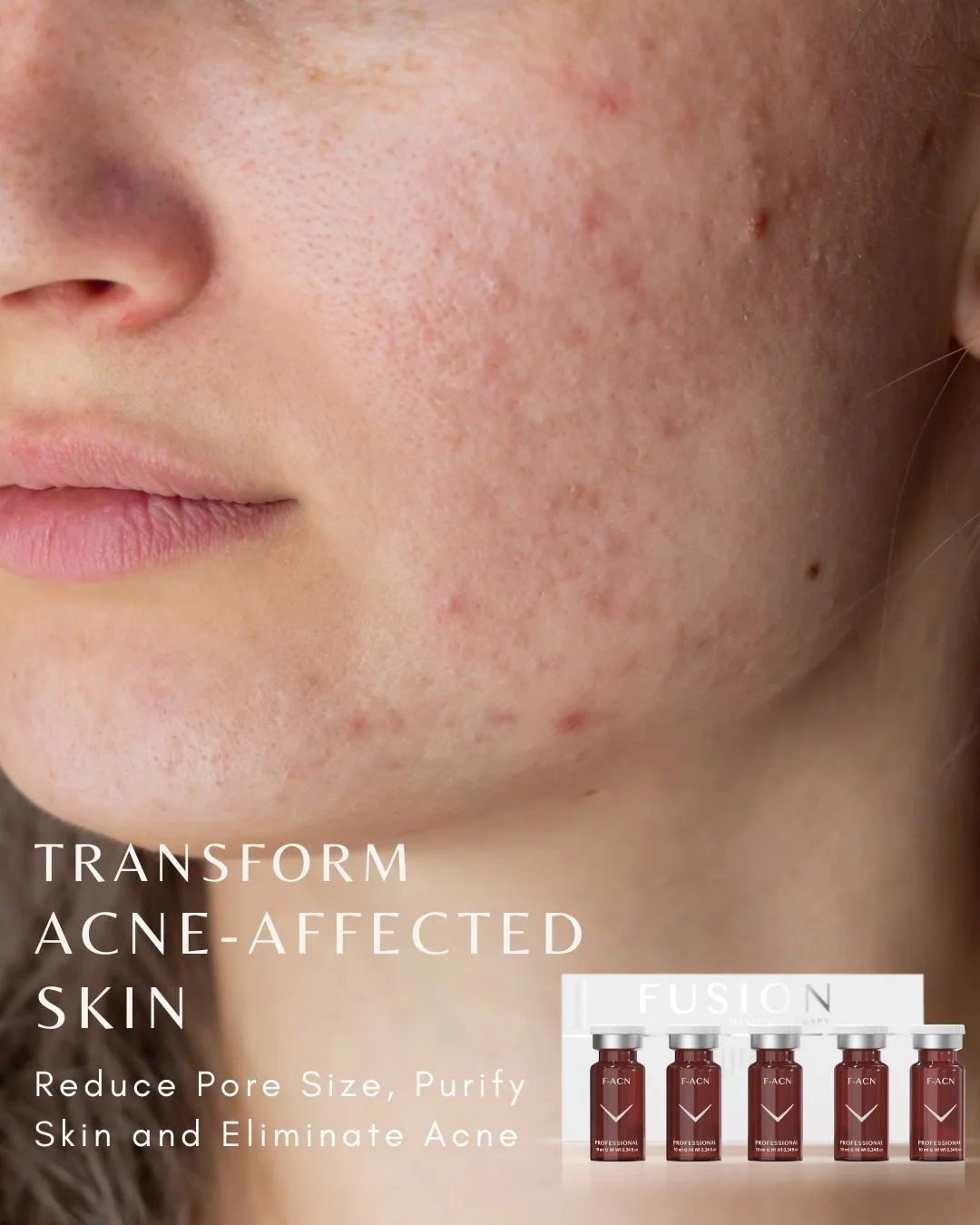Say goodbye to acne, blemishes and breakouts!