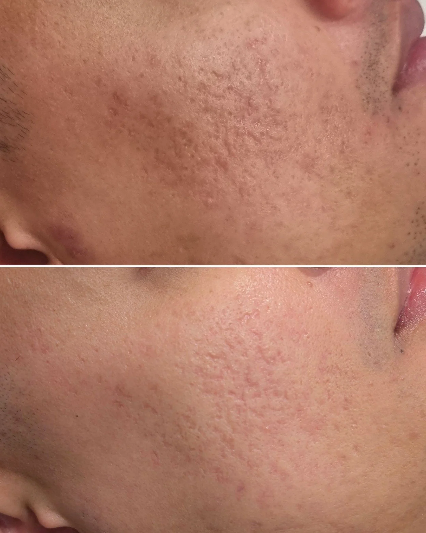 ✨ Scarring can leave more than just a mark on our skin; it can also impact our self-confidence and how we see ourselves. 🌼 Whether it's from surgery, acne, or an accident, many of us face the emotional challenges that come with visible scars.
💖 We