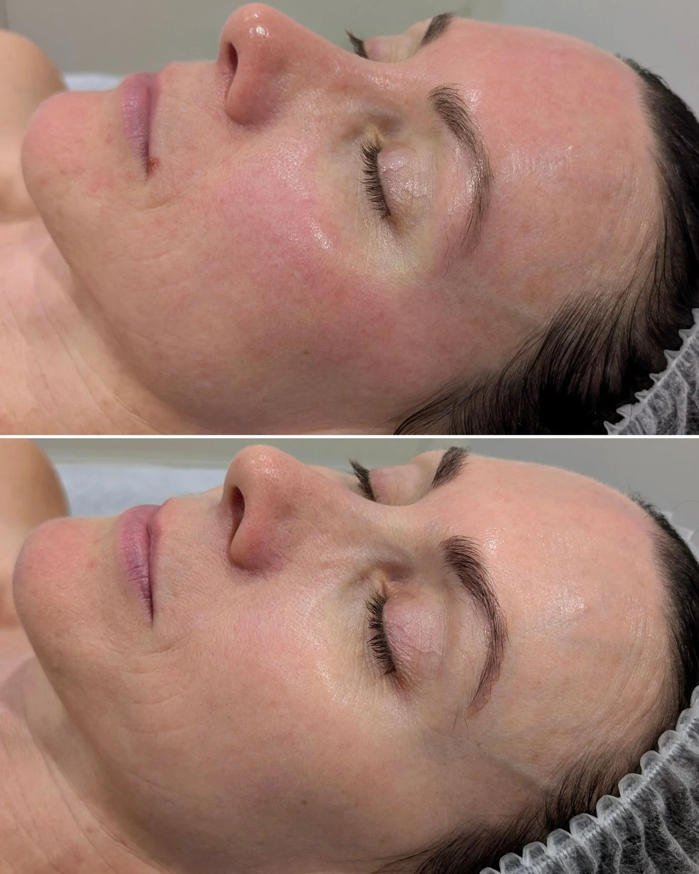 𝗦𝗘𝗡𝗦𝗜𝗧𝗜𝗩𝗜𝗧𝗬, 𝗖𝗢𝗠𝗣𝗥𝗢𝗠𝗜𝗦𝗘𝗗 𝗕𝗔𝗥𝗥𝗜𝗘𝗥, 𝗥𝗘𝗗𝗡𝗘𝗦𝗦, 𝗥𝗘𝗔𝗖𝗧𝗜𝗩𝗘 𝗦𝗞𝗜𝗡

Whatever it's called and whatever it means to you, we are here to help.

Our client came to us mainly wanting to prevent ageing. Before we begin